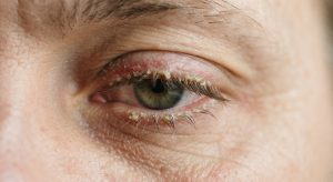 What That Yellow Stuff in Your Eyes Really Means When You Wake Up